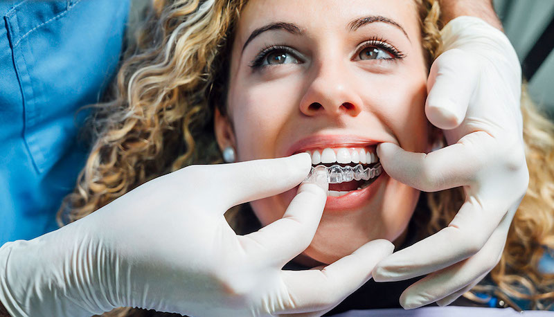 Invisalign1