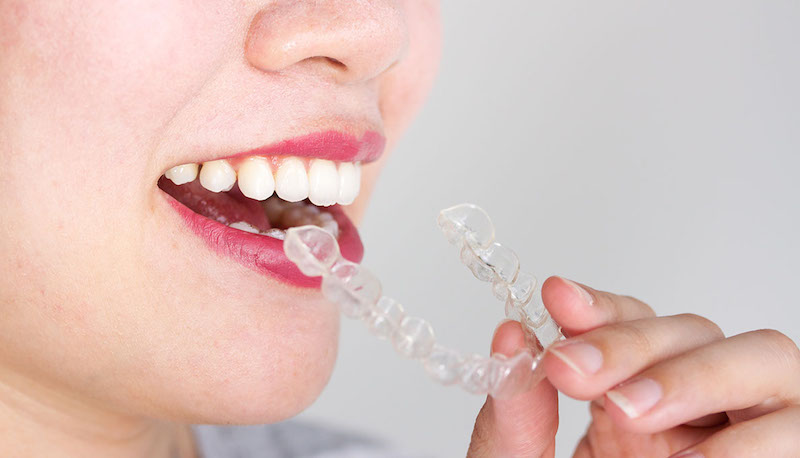 Invisalign3